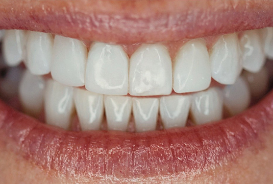 After - Ascot Dental Suite