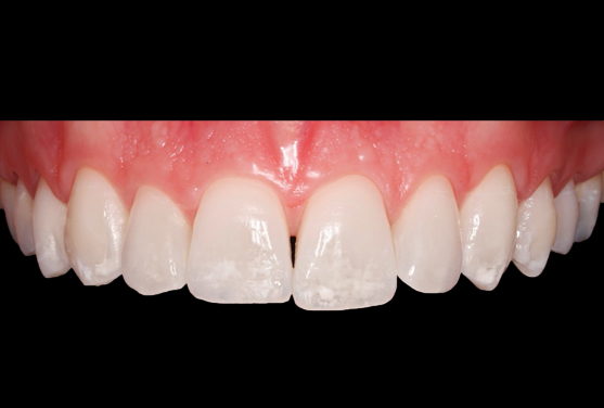 Before and After Composite Bonding