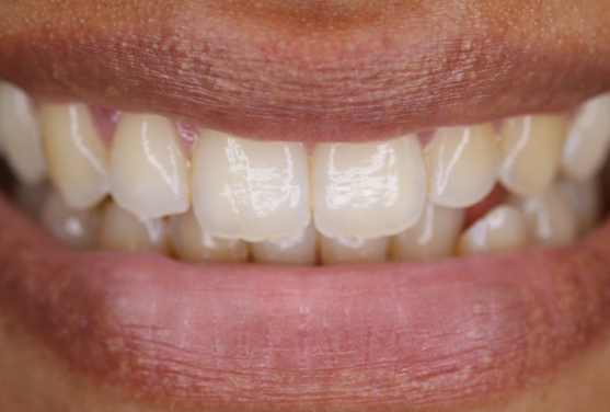 Before - Ascot Dental Suite
